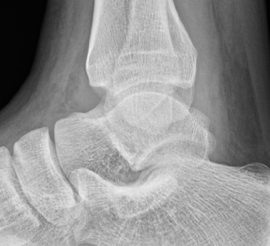 Ankle effusion