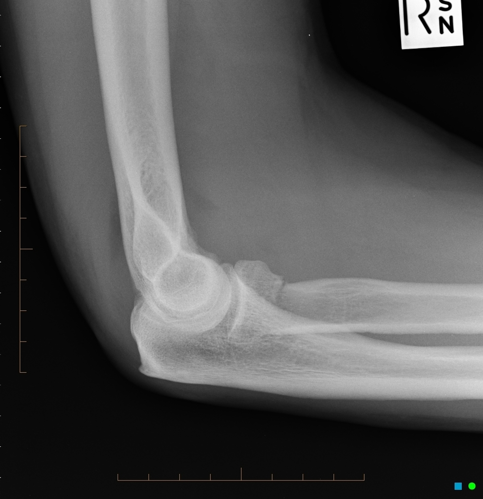 Elbow effusion
