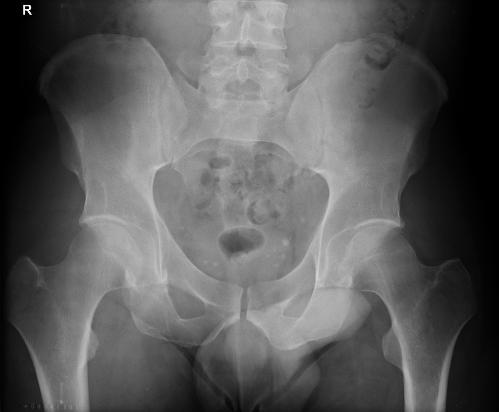 Hip effusion