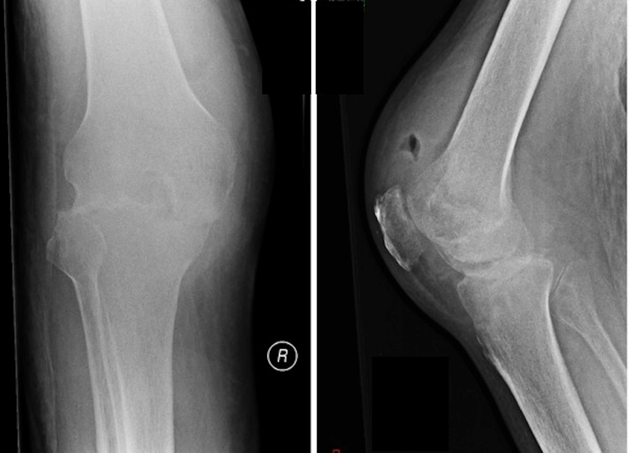 Knee Septic Arthritis