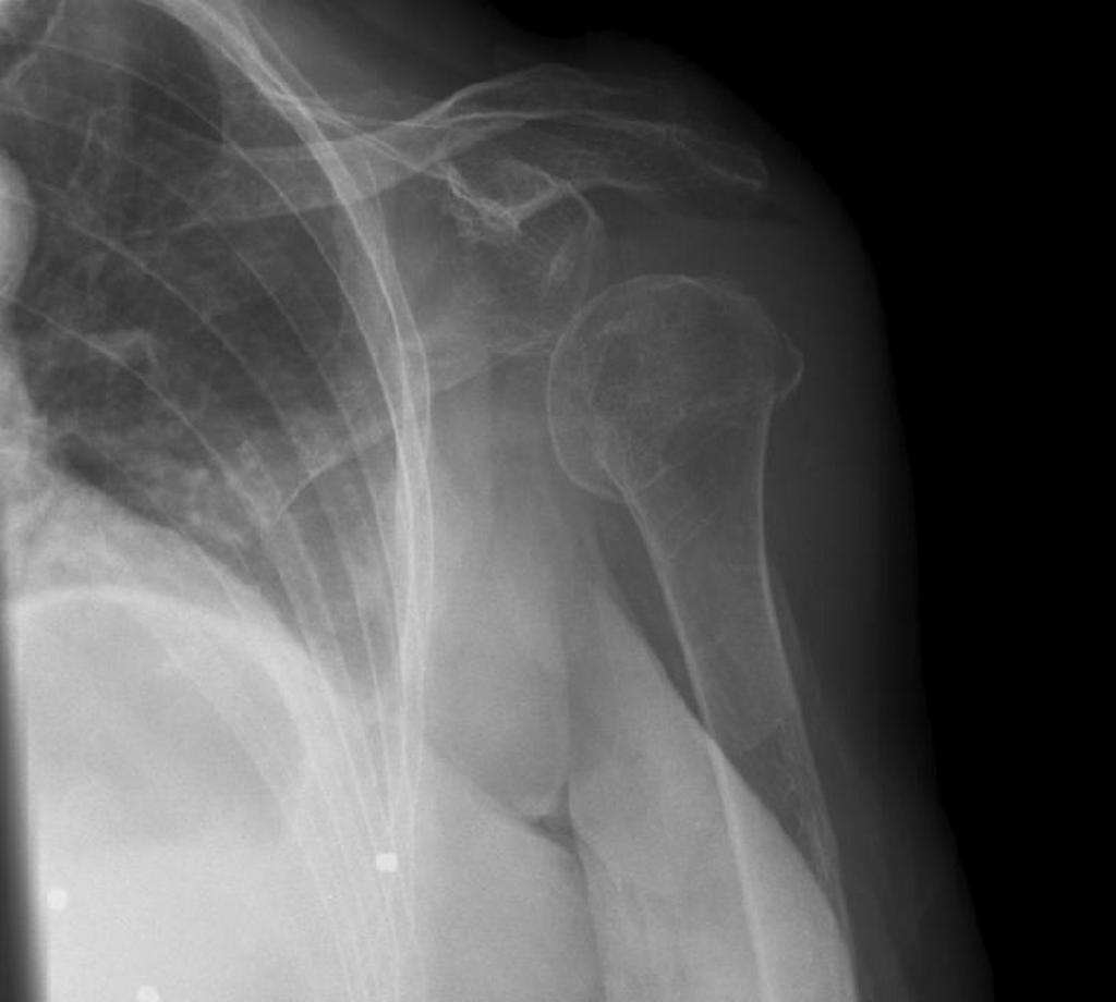 Knee Septic Arthritis