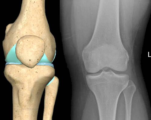3D rendering of a knee next to an AP knee X-ray